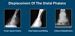 Displacement Of The Distal Phalanx