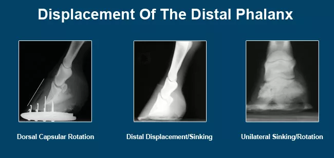 Displacement Of The Distal Phalanx