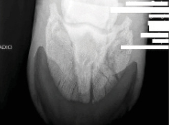 PIII-fracture-fig-1.jpg
