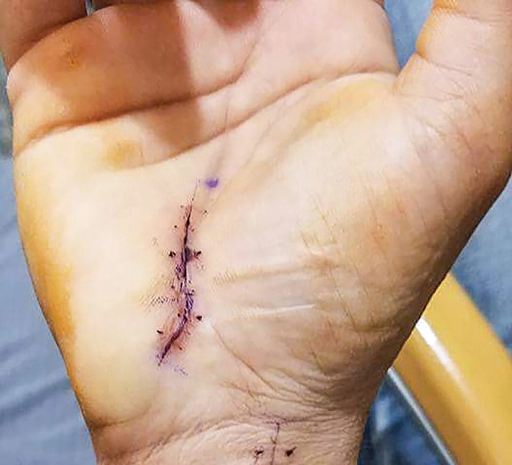 Carpal Tunnel Syndrome Surgery Scar