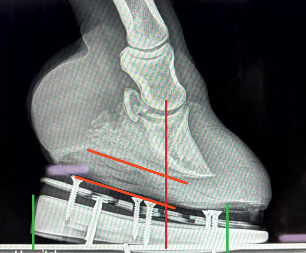 A-Biomechanical-Approach-to-Managing-Club-Feet-Fig-11.jpg