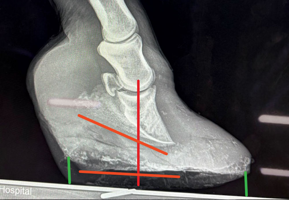 A-Biomechanical-Approach-to-Managing-Club-Feet-Fig-3.jpg